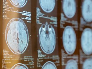 Close-up of brain MRI scan images displayed on a medical monitor for neurological diagnosis and radiology evaluation.